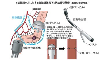 【大腸がん手術後】術後はじめての食事「重湯」が美味しかった理由｜入院体験記 （キーワード：大腸がん、術後食事、重湯、回復、入院生活）